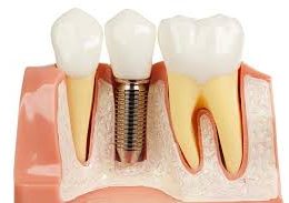 dental-implant [object object] مراقبت های پس از درمان ریشه afaf 260x183  مطالب دندانپزشکی afaf 260x183