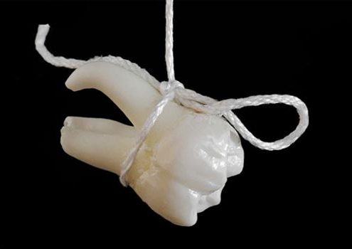 جراحی دندان [object object] مراقبت های پس از درمان ریشه jarhidandan 495x350