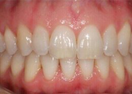 کريز لاین یا خط عمودی بر روی دندان [object object] مراقبت های پس از درمان ریشه kerizline 260x185  مطالب دندانپزشکی kerizline 260x185