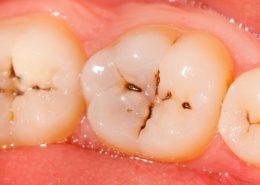 پوسیدگی دندان [object object] مراقبت های پس از درمان ریشه posedegi 260x185  مطالب دندانپزشکی posedegi 260x185
