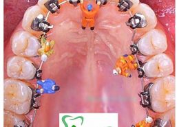 ارتودنسی در کلینیک آرسته [object object] مراقبت های پس از درمان ریشه clinicarasteh N1 260x185  مطالب دندانپزشکی clinicarasteh N1 260x185
