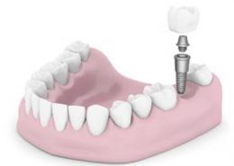 مراقبت پس از ایمپلنت [object object] مراقبت های پس از درمان ریشه 83 260x185  مطالب دندانپزشکی 83 260x185