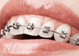 ارتودنسی [object object] مراقبت های پس از درمان ریشه index braces 260x185  مطالب دندانپزشکی index braces 260x185