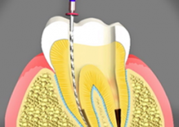 کانال ریشه [object object] مراقبت های پس از درمان ریشه root canal treatment 260x185  مطالب دندانپزشکی root canal treatment 260x185