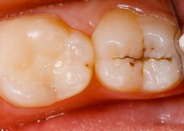 پوسیدگی دندان آراسته [object object] مراقبت های پس از درمان ریشه arasteh1 260x185  مطالب دندانپزشکی arasteh1 260x185
