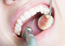 ترمیم دندان کلینیک دندانپزشکی آراسته شیراز [object object] مراقبت های پس از درمان ریشه 1 260x185  مطالب دندانپزشکی 1 260x185