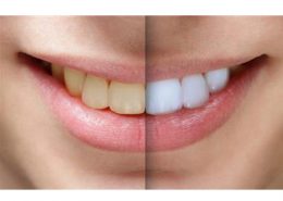 کلینیک دندانپزشکی آرسته [object object] مراقبت های پس از درمان ریشه 14 260x185  مطالب دندانپزشکی 14 260x185