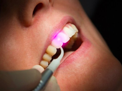 دندانپزشکی آرسته در شیراز  جراحی لثه با لیزر 30