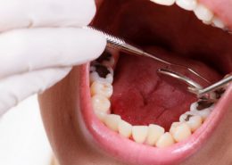 پوسیدگی دندان چیست [object object] مراقبت های پس از درمان ریشه 60 260x185  مطالب دندانپزشکی 60 260x185