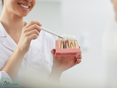 دندانپزشکی آرسته در شیراز ایمپلنت دندان ایمپلنت دندان 3