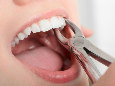 دندانپزشکی آرسته در شیراز نکات مهم درباره دندان عقل کشیدن دندان عقل 88