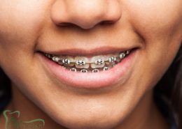[object object] مراقبت های پس از درمان ریشه orthodontic 260x185  مطالب دندانپزشکی orthodontic 260x185