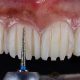 تراشیدن دندانها برای نصب لمینت  ارتودنسی لینگوال Untitled 1 1 80x80