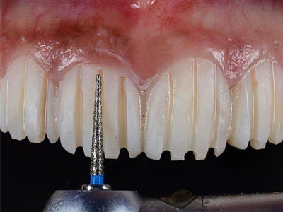 تراشیدن دندانها برای نصب لمینت  تراشیدن دندان جهت نصب لمینت Untitled 1 1