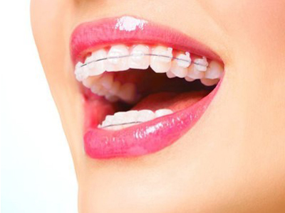 ارتودنسی و تغییر فرم لب ها  مرتب کردن دندان بدون ارتودنسی Untitled 1 1