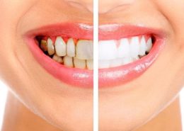 تفاوت بلیچینگ و جرمگیری دندان [object object] مراقبت های پس از درمان ریشه Untitled 1 1 260x185  مطالب دندانپزشکی Untitled 1 1 260x185