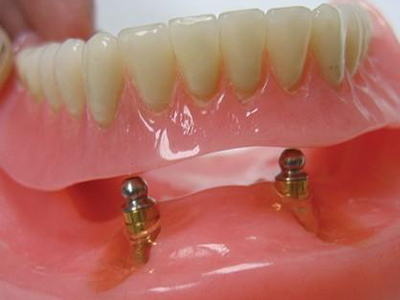 ایمپلنت نگهدارنده دست دندان ایمپلنت ایمپلنت نگهدارنده دست دندان Untitled 1