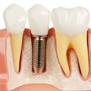 dental-implant ايمپلنت دندانى (dental implant) ايمپلنت دندانى (Dental Implant) afaf 180x180