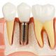 dental-implant مراقبت های پس از گذاشتن بریج و روکش مراقبت های بعد از بریج و روکش afaf 80x80