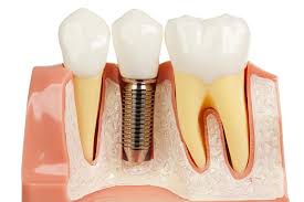 dental-implant ايمپلنت دندانى (dental implant) ايمپلنت دندانى (Dental Implant) afaf