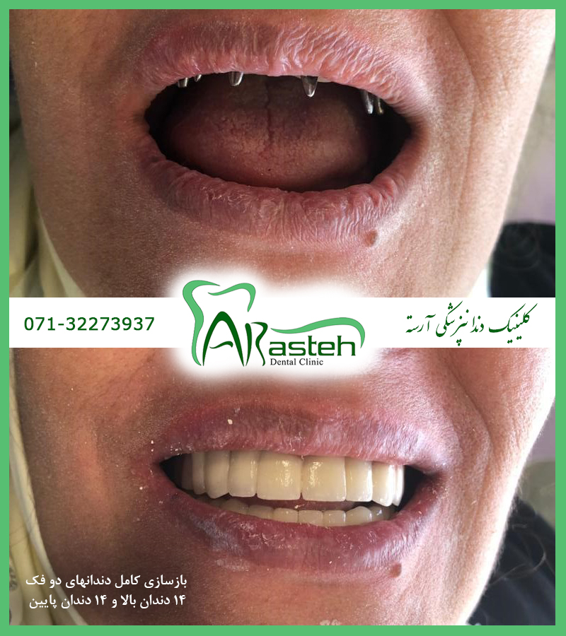 ایمپلنت در شیراز تصاویر قبل و بعد دندانپزشکی،قبل و بعد،before and after قبل و بعد درمان ax implant1