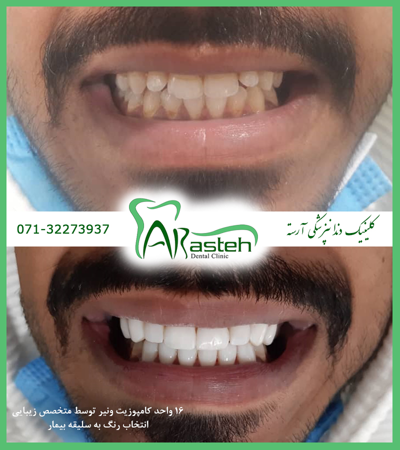 تصاویر قبل و بعد دندانپزشکی،قبل و بعد،before and after قبل و بعد درمان composite veneer 1