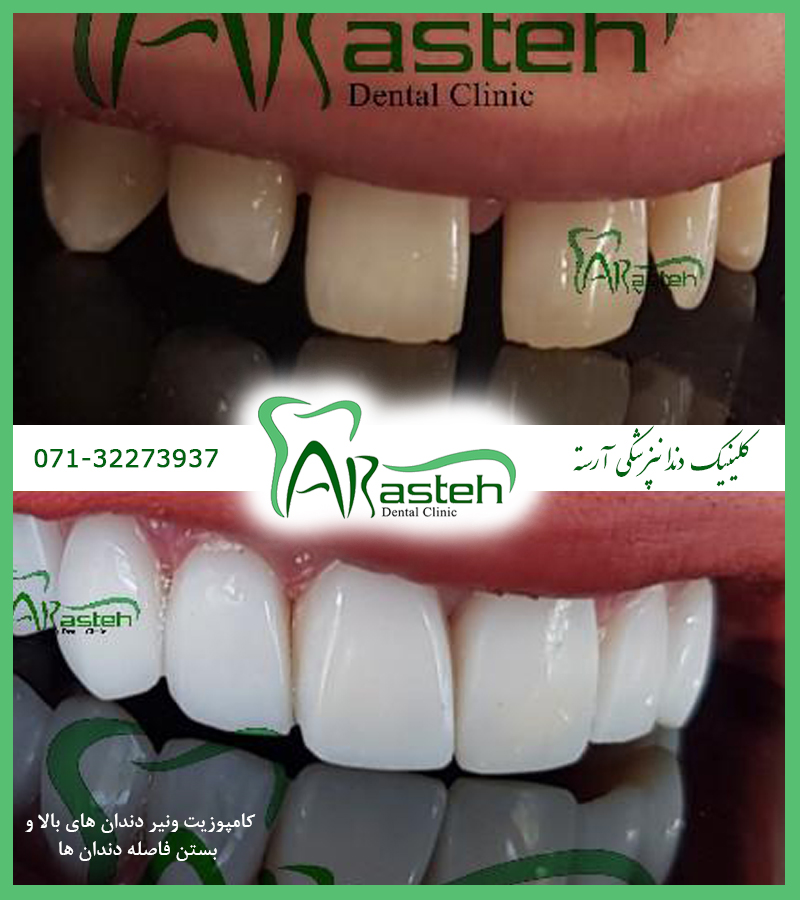 کامپوزیت ونیر در شیراز تصاویر قبل و بعد دندانپزشکی،قبل و بعد،before and after قبل و بعد درمان composite veneer