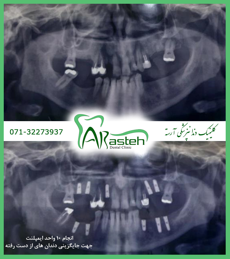 تصاویر قبل و بعد دندانپزشکی،قبل و بعد،before and after قبل و بعد درمان implant gallery1