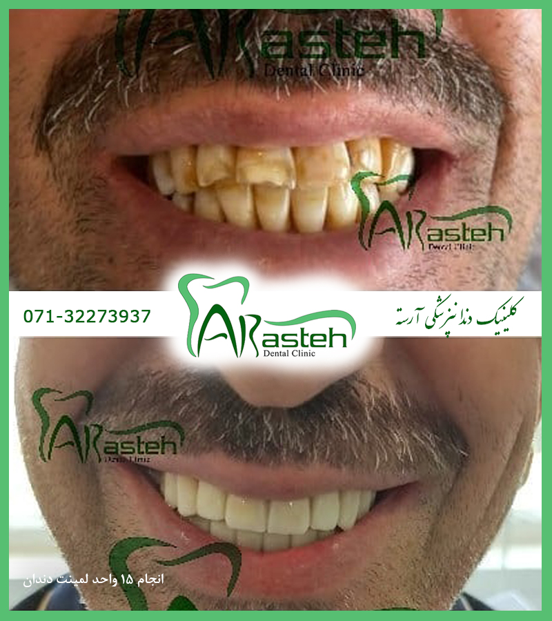 تصاویر قبل و بعد دندانپزشکی،قبل و بعد،before and after قبل و بعد درمان laminate gallery3