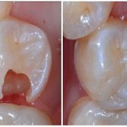 ترمیم دندان مراقبت های پس از ترمیم دندان مراقبت های پس از ترمیم دندان tarmimdandan 180x180