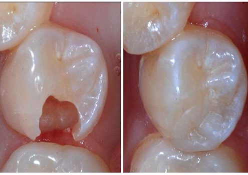 ترمیم دندان [object object] مراقبت های پس از درمان ریشه tarmimdandan 495x350