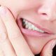 دندان قروچه کريز لاین یا خط عمودی بر روی دندان چیست؟ کريز لاین یا خط عمودی بر روی دندان چیست؟ beraksism 80x80
