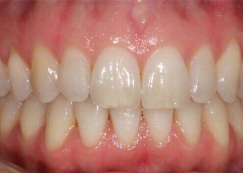 کريز لاین یا خط عمودی بر روی دندان ايمپلنت دندانى (dental implant) ايمپلنت دندانى (Dental Implant) kerizline 495x352