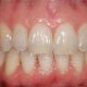 کريز لاین یا خط عمودی بر روی دندان دندان قروچه دندان قروچه یا براکسيسم چيست؟ kerizline 80x80