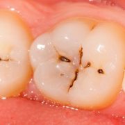 پوسیدگی دندان آیا درمان پوسیدگی های سطحی دندان اهمیت دارد؟ آیا درمان پوسیدگی های سطحی دندان اهمیت دارد؟ posedegi 180x180