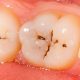 پوسیدگی دندان  اول مسواک یا نخ دندان posedegi 80x80