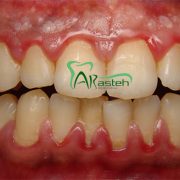 بیماری های لثه نشانه های مخفی بیماری های لثه نشانه های مخفی بیماری های لثه Gum disease 180x180