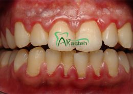 بیماری های لثه [object object] مراقبت های پس از درمان ریشه Gum disease 260x185  مطالب دندانپزشکی Gum disease 260x185