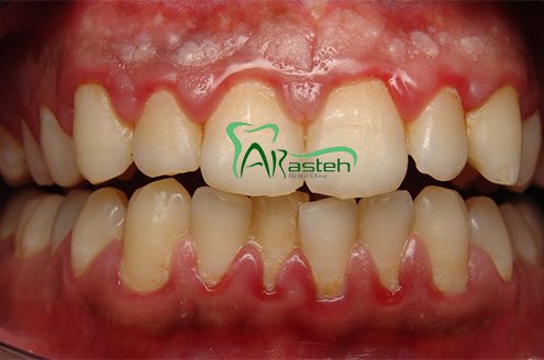 بیماری های لثه نشانه های مخفی بیماری های لثه نشانه های مخفی بیماری های لثه Gum disease 495x328