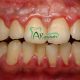 بیماری های لثه کريز لاین یا خط عمودی بر روی دندان چیست؟ کريز لاین یا خط عمودی بر روی دندان چیست؟ Gum disease 80x80