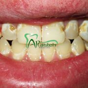 پوسیدگی دندان چه موادی باعث پیشگیری از پوسیدگی دندان ها می شوند؟ چه موادی باعث پیشگیری از پوسیدگی دندان ها می شوند؟ arasteh1456 180x180