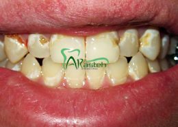 پوسیدگی دندان [object object] مراقبت های پس از درمان ریشه arasteh1456 260x185  مطالب دندانپزشکی arasteh1456 260x185