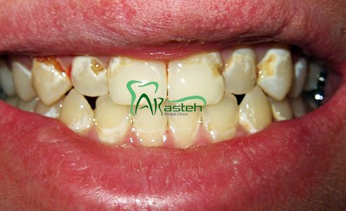 پوسیدگی دندان آیا درمان پوسیدگی های سطحی دندان اهمیت دارد؟ آیا درمان پوسیدگی های سطحی دندان اهمیت دارد؟ arasteh1456 495x302