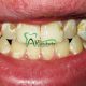 پوسیدگی دندان تاثیر شیرینی جات در سلامت دندان ها تاثیر شیرینی جات در سلامت دندان ها arasteh1456 80x80