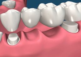 روکش های دندانی [object object] مراقبت های پس از درمان ریشه dental 260x185  مطالب دندانپزشکی dental 260x185