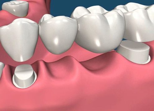 روکش های دندانی  انتخاب روکش مناسب برای دندان dental 495x359