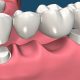 روکش های دندانی  شکلات تلخ،به سلامت دندان کمک میکند dental 80x80