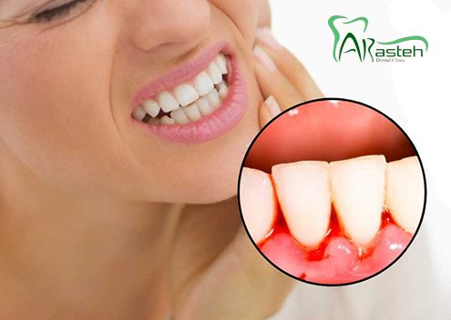 خونریزی لثه  انتخاب روکش مناسب برای دندان arasteh Bleeding gums 1 495x352
