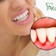خونریزی لثه  شکلات تلخ،به سلامت دندان کمک میکند arasteh Bleeding gums 1 80x80