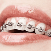 ارتودنسی  مراقبت های پس از ارتودنسی index braces 180x180